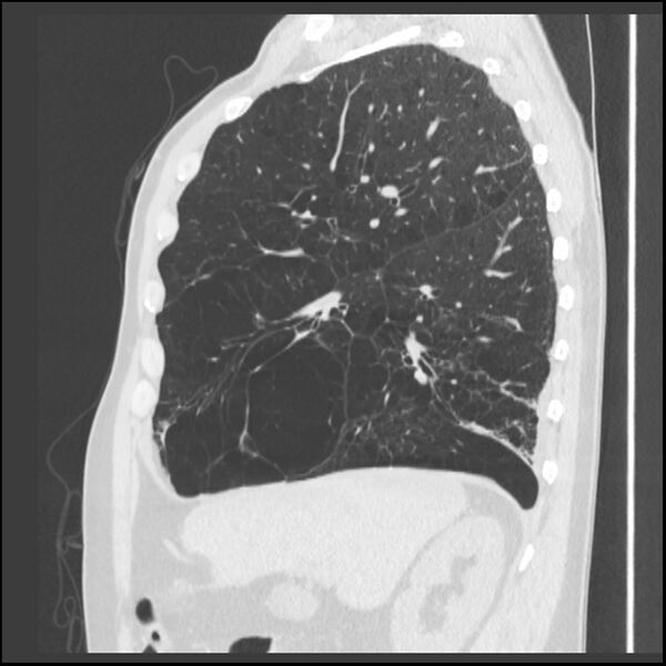 File:Alpha-1-antitrypsin deficiency (Radiopaedia 40993-43722 Sagittal lung window 184).jpg