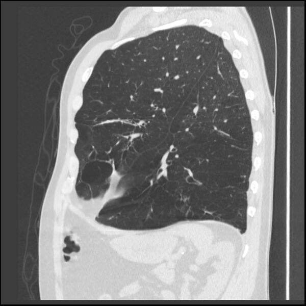 File:Alpha-1-antitrypsin deficiency (Radiopaedia 40993-43722 Sagittal lung window 78).jpg