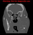 Ameloblastoma (Radiopaedia 13276-13280 Coronal non-contrast 14).jpg