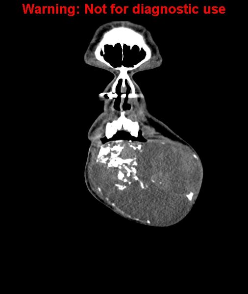 File:Ameloblastoma (Radiopaedia 33126-34164 D 12).jpg