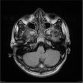Amnestic syndrome secondary to hypoxic brain injury (Radiopaedia 24743-25004 FLAIR 4).jpg