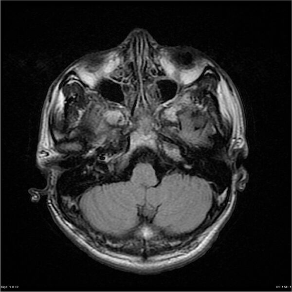 File:Amnestic syndrome secondary to hypoxic brain injury (Radiopaedia 24743-25004 FLAIR 4).jpg