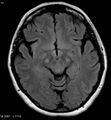 Amyotrophic lateral sclerosis (Radiopaedia 5373-7134 Axial FLAIR 11).jpg