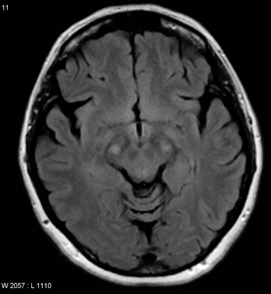 File:Amyotrophic lateral sclerosis (Radiopaedia 5373-7134 Axial FLAIR 11).jpg