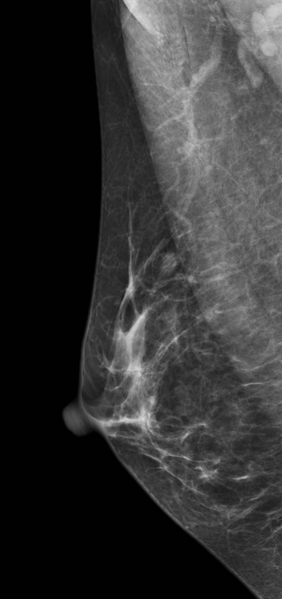 File:Analog versus digital breast imaging (Radiopaedia 22364-22387 MLO 1).png