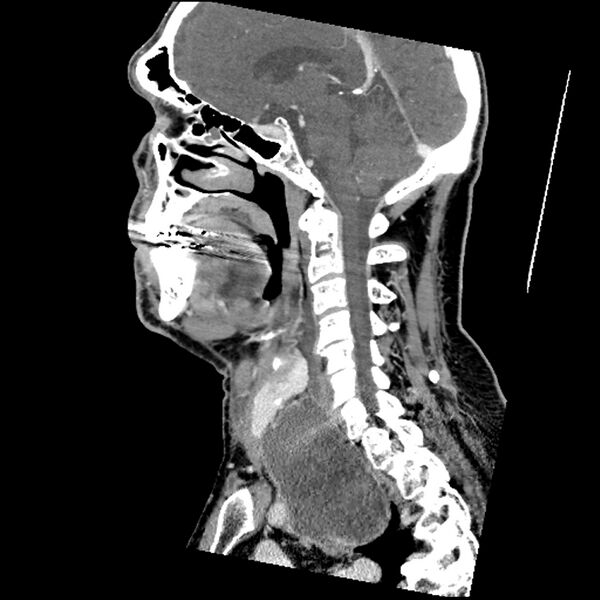 File:Anaplastic thyroid carcinoma (Radiopaedia 79087-92034 C 43).jpg