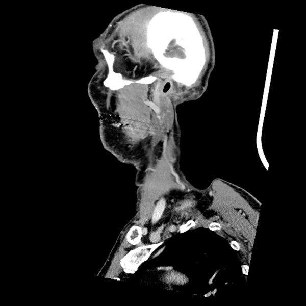 File:Anaplastic thyroid carcinoma (Radiopaedia 79087-92034 C 77).jpg