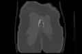 Aneurysmal bone cyst of ischium (Radiopaedia 25957-26094 Coronal bone window 47).png