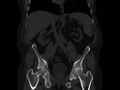 Ankylosing spondylitis (Radiopaedia 44609-48357 Coronal bone window 36).jpg