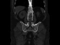 Ankylosing spondylitis (Radiopaedia 44609-48357 Coronal bone window 68).jpg