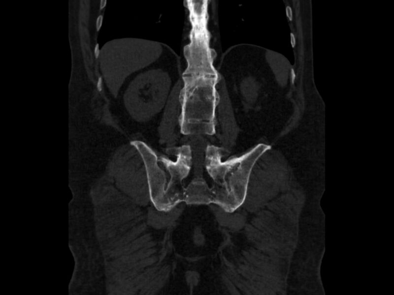 File:Ankylosing spondylitis (Radiopaedia 44609-48357 Coronal bone window 68).jpg