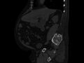 Ankylosing spondylitis (Radiopaedia 44609-48357 Sagittal bone window 37).jpg
