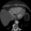 Anomalous origin of left circumflex artery from right coronary sinus (Radiopaedia 72563-83117 B 144).jpg