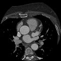 Anomalous origin of left circumflex artery from right coronary sinus (Radiopaedia 72563-83117 B 31).jpg