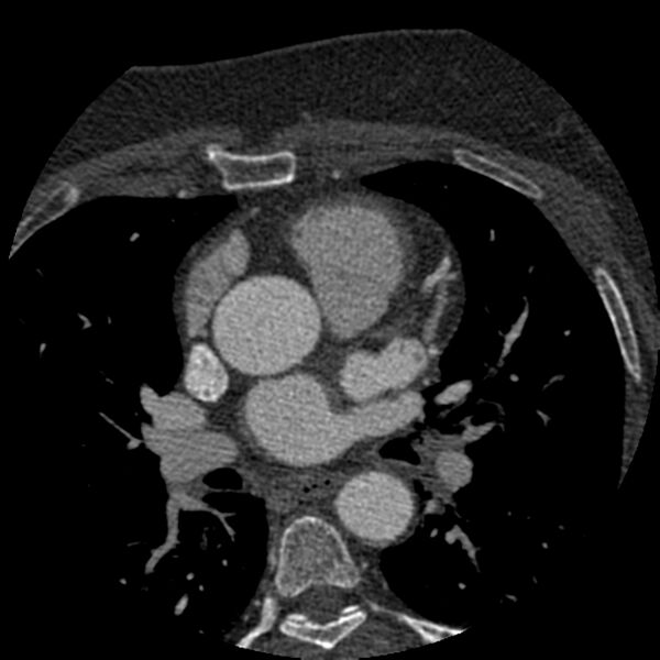 File:Anomalous origin of left circumflex artery from right coronary sinus (Radiopaedia 72563-83117 B 31).jpg