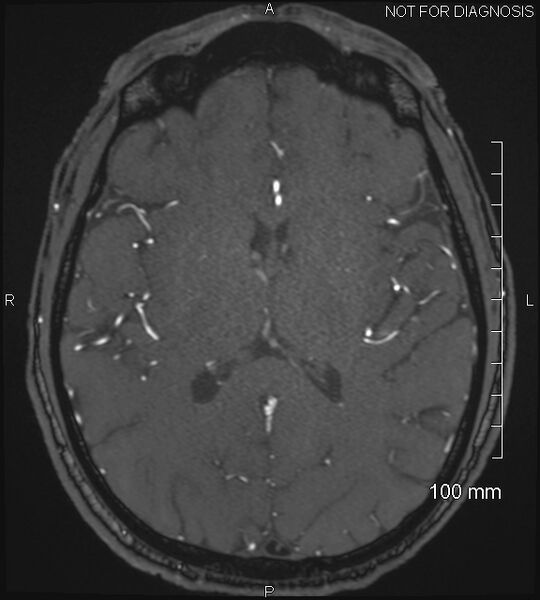 File:Anterior cerebral artery aneurysm (Radiopaedia 80683-94127 Axial MRA 137).jpg
