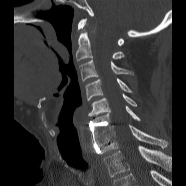 File:Anterior cervical postdiscectomy arthrodesis (Radiopaedia 32678-33646 Sagittal bone window 40).jpg