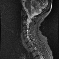 Anterior spinal artery syndrome (Radiopaedia 46335-50750 Sagittal STIR 4).png