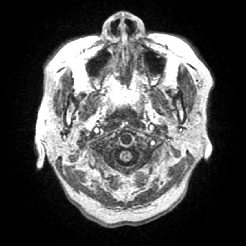 Anti-MOG encephalomyelitis (Radiopaedia 73831-84646 Axial T1 2).jpg