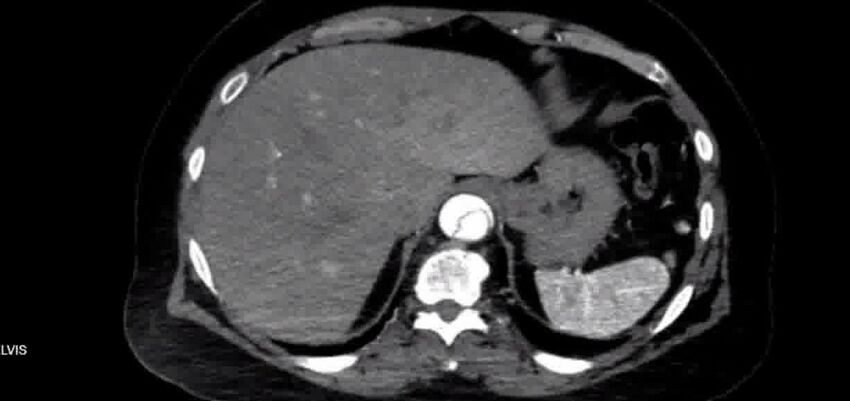 Aortic Dissection (Radiopaedia 85272-100847 A 41).jpg
