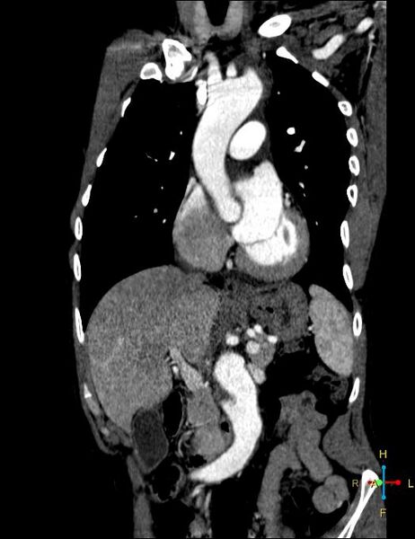 File:Aortic aneurysm and penetrating ulcer (Radiopaedia 23590-23704 B 2).jpg