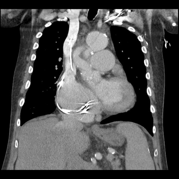 File:Aortic arch graft infection (FDG PET-CT) (Radiopaedia 71975-82437 Coronal 28).jpg