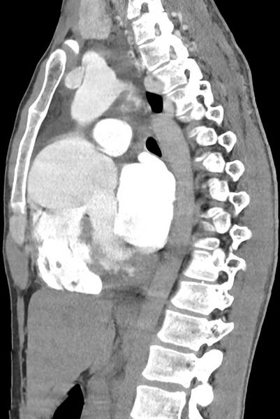 File:Aortic coarctation with aneurysm (Radiopaedia 74818-85828 B 89).jpg