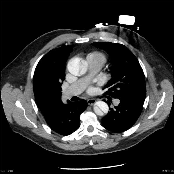 File:Aortic dissection- Stanford A (Radiopaedia 37759-39664 A 32).jpg