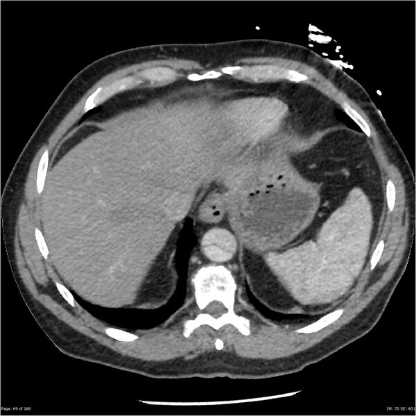 File:Aortic dissection- Stanford A (Radiopaedia 37759-39664 A 60).jpg