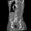 Aortic dissection (Radiopaedia 68763-78691 B 27).jpeg