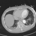 Aortic dissection - DeBakey type II (Radiopaedia 64302-73082 Axial lung window 49).png