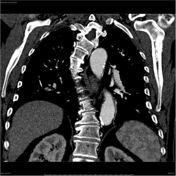 File:Aortic dissection - Stanford type A (Radiopaedia 26183-26315 A 49).jpg
