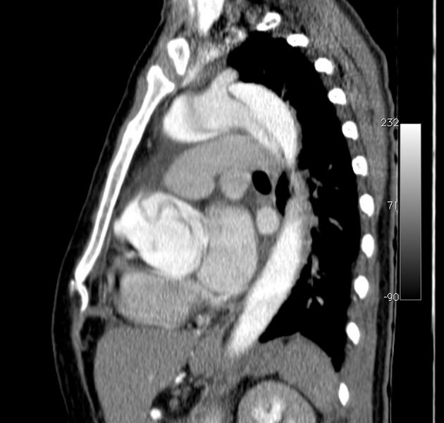 File:Aortic dissection - Stanford type A (Radiopaedia 29247-29659 C 21).jpg