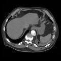 Aortic dissection with rupture into pericardium (Radiopaedia 12384-12647 A 47).jpg