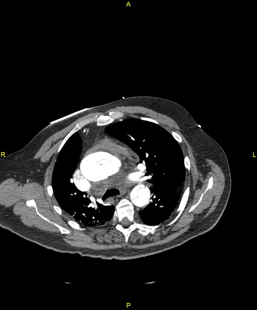 Aortic rupture (Radiopaedia 88822-105594 B 86).jpg