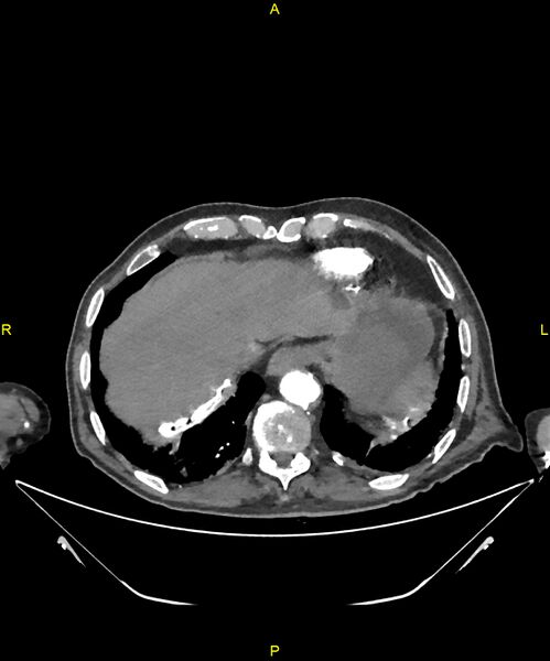 File:Aortoenteric fistula (Radiopaedia 84308-99603 B 24).jpg