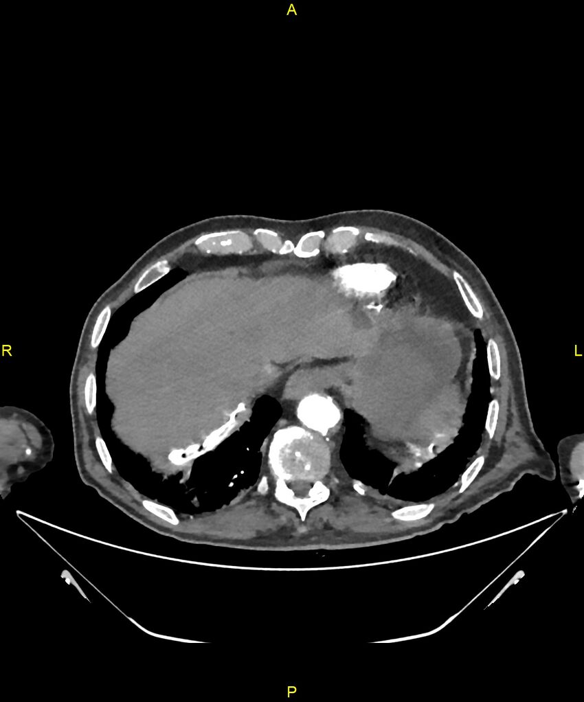 Aortoenteric fistula (Radiopaedia 84308-99603 B 24).jpg