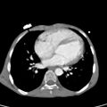 Aortopulmonary window, interrupted aortic arch and large PDA giving the descending aorta (Radiopaedia 35573-37074 B 54).jpg