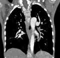 Aortopulmonary window, interrupted aortic arch and large PDA giving the descending aorta (Radiopaedia 35573-37074 D 45).jpg