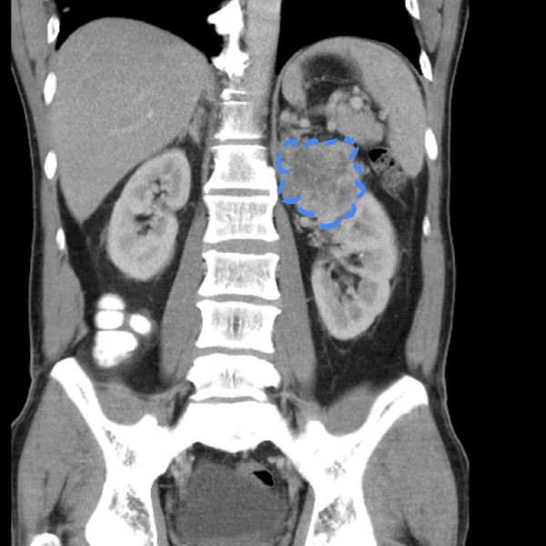 File:Appendicitis and renal cell carcinoma (Radiopaedia 17063-18402 C 1).png