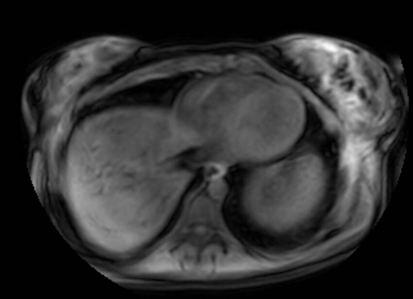Appendicitis in gravida (MRI) (Radiopaedia 89433-106395 Axial DIXON 1).jpg