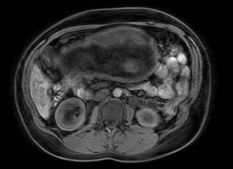 File:Appendicitis in gravida (MRI) (Radiopaedia 89433-106395 Axial DIXON 58).jpg