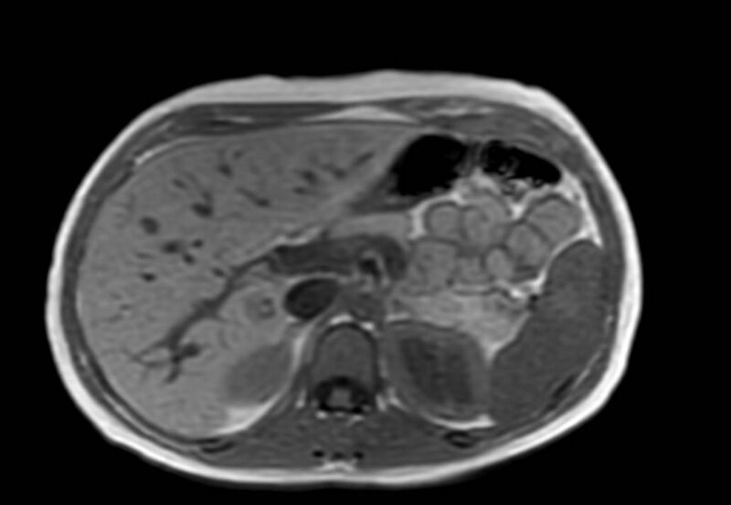 File:Appendicitis in gravida (MRI) (Radiopaedia 89433-106395 Axial T1 in-phase 15).jpg