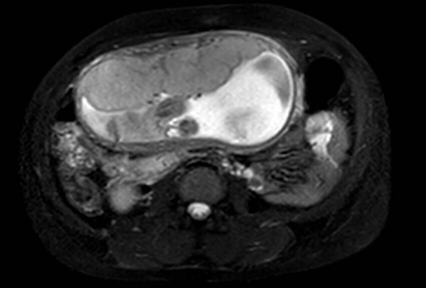 Appendicitis in gravida (MRI) (Radiopaedia 89433-106395 Axial T2 SPAIR 38).jpg