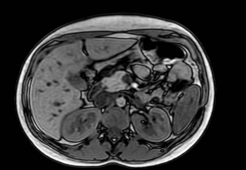 File:Appendicitis in gravida (MRI) (Radiopaedia 89433-106395 D 19).jpg