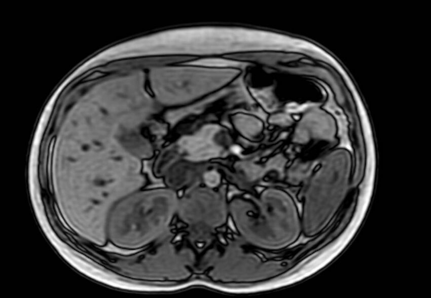 Appendicitis in gravida (MRI) (Radiopaedia 89433-106395 D 19).jpg