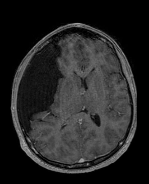 File:Arachnoid cyst- extremely large (Radiopaedia 68741-78451 Axial T1 C+ 45).jpg