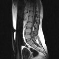 Arachnoid cyst - spinal (Radiopaedia 66835-76157 Sagittal T1 5).jpg
