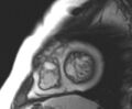 Arrhythmogenic right ventricular cardiomyopathy (Radiopaedia 69431-79307 Short axis cine 40).jpg