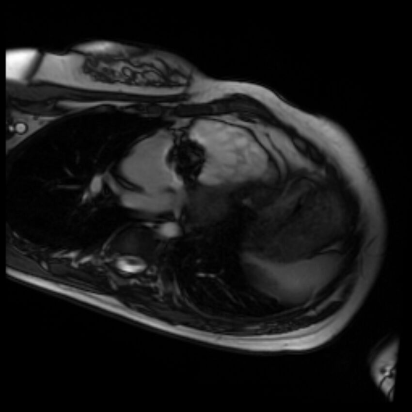 Arrhythmogenic right ventricular cardiomyopathy (Radiopaedia 87505-103850 4ch Cine SSFP 88).jpg